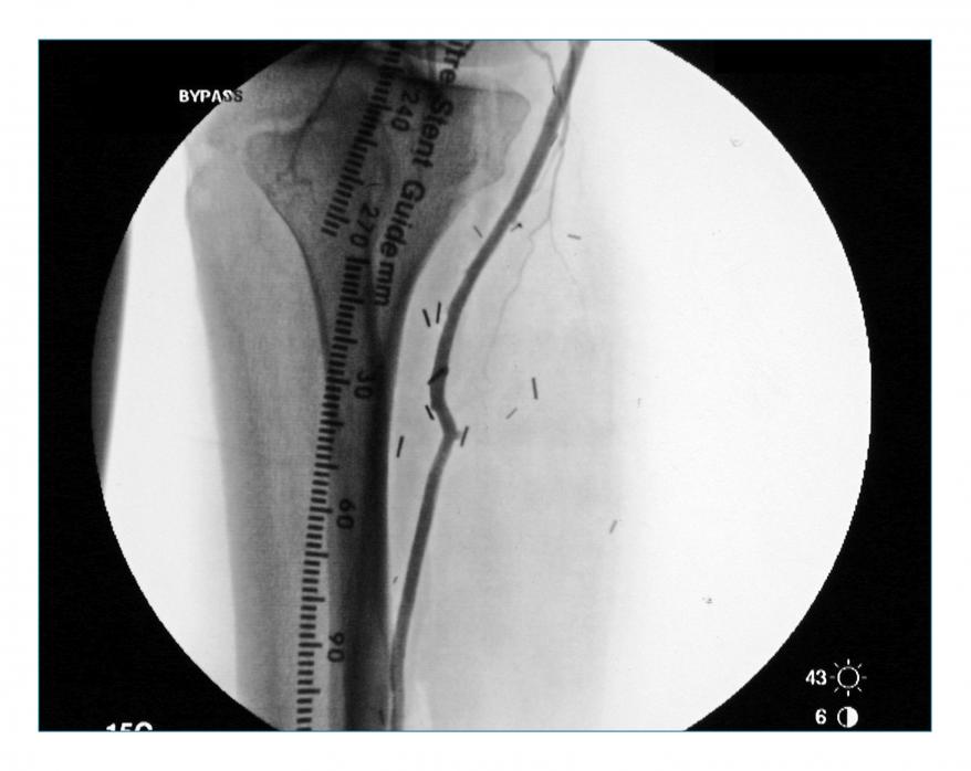 DeviceMD - VascuTape® Radiopaque Tape
