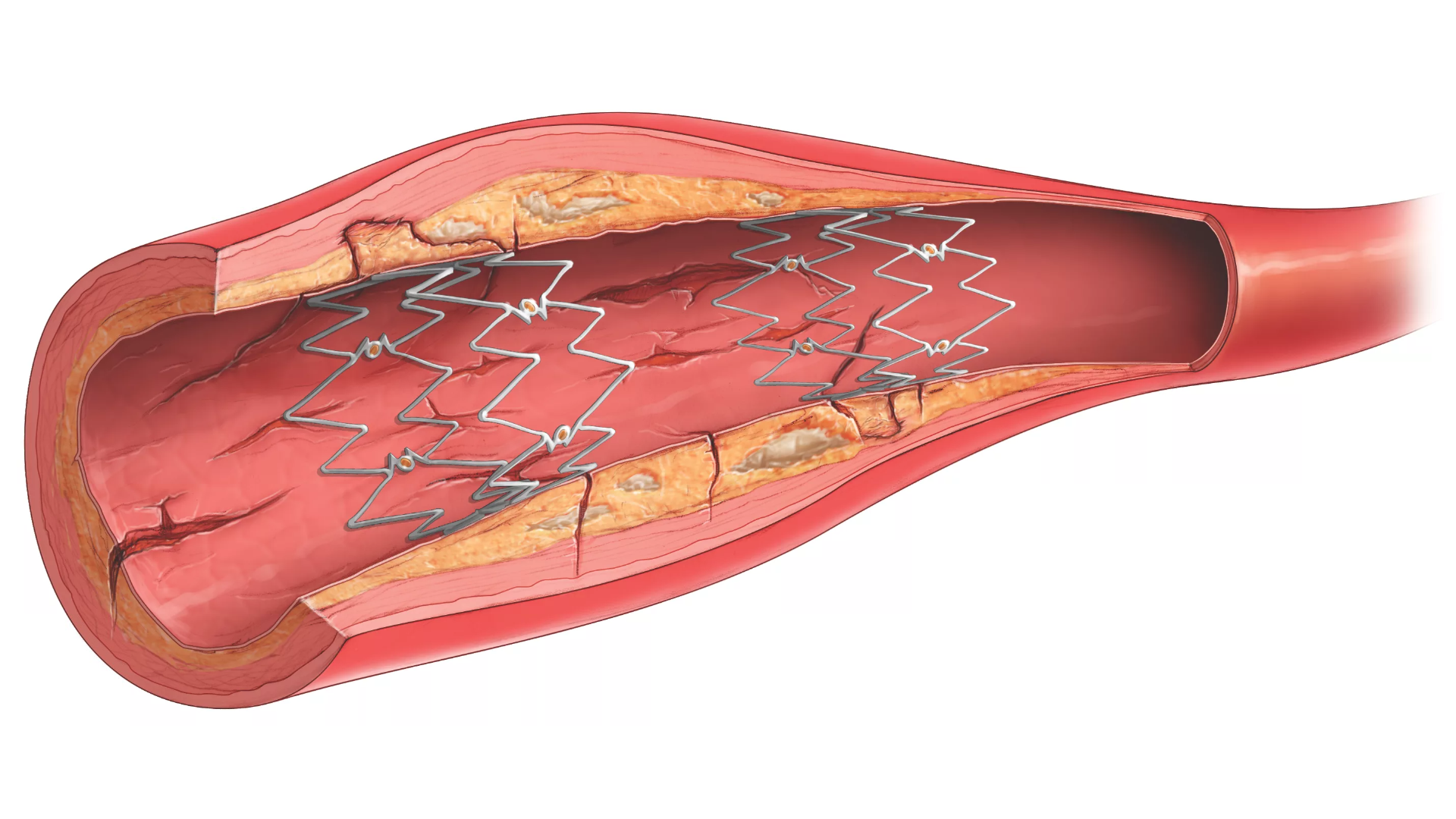 DeviceMD - Tack endovascular system